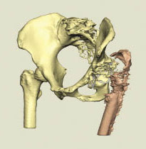 Displaced cage hip dislocation visualized in Geomagic Freeform direct from CT scan data.